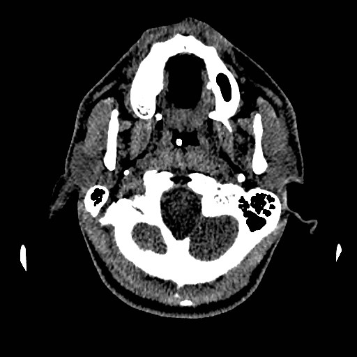 Acute basilar artery occlusion (Radiopaedia 43582-46985 Axial non-contrast 29).jpg
