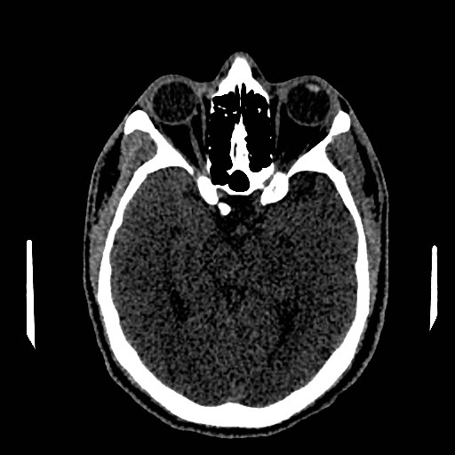 Acute basilar artery occlusion (Radiopaedia 43582-46985 Axial non-contrast 81).jpg