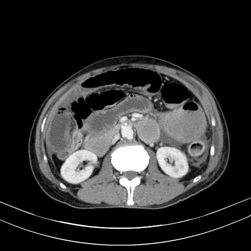 Acute bowel ischemia (Radiopaedia 87695-104114 Axial C+ portal venous phase 38).jpg