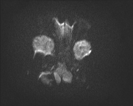 File:Acute cerebellar ataxia (Radiopaedia 61487-69446 Axial DWI 3).jpg