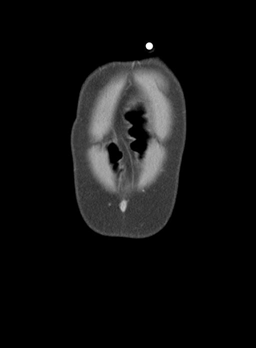 Acute cholecystitis (Radiopaedia 29814-30327 Coronal C+ portal venous phase 4).jpg