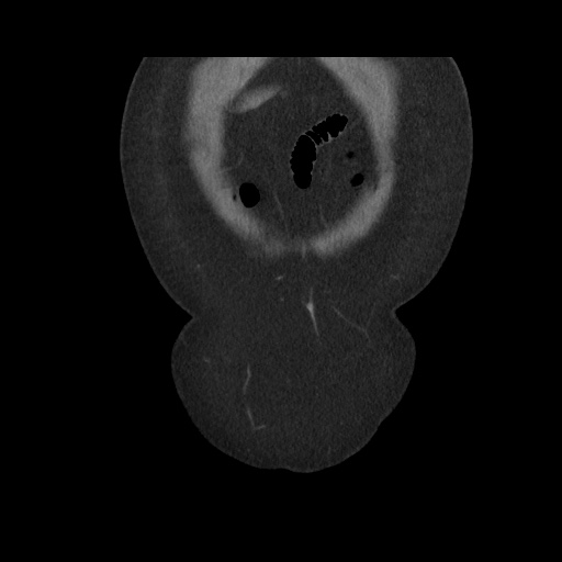 Acute cholecystitis with tensile fundus sign (Radiopaedia 71394-81723 Coronal non-contrast 22).jpg