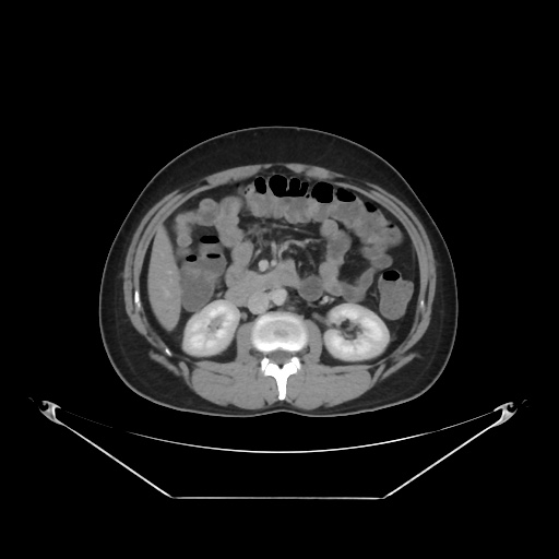 File:Acute complicated calculous cholecystitis (Radiopaedia 55202-61587 Axial C+ delayed 47).jpg