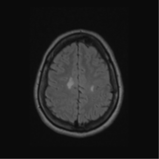 Acute disseminated encephalomyelitis (ADEM) (Radiopaedia 38073-40065 Axial FLAIR 52).png