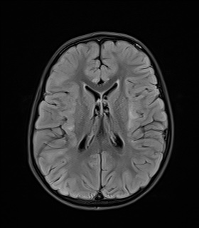 File:Acute disseminating encephalomyelitis with bilateral optic neuritis (Radiopaedia 79676-92886 Axial FLAIR 15).jpg