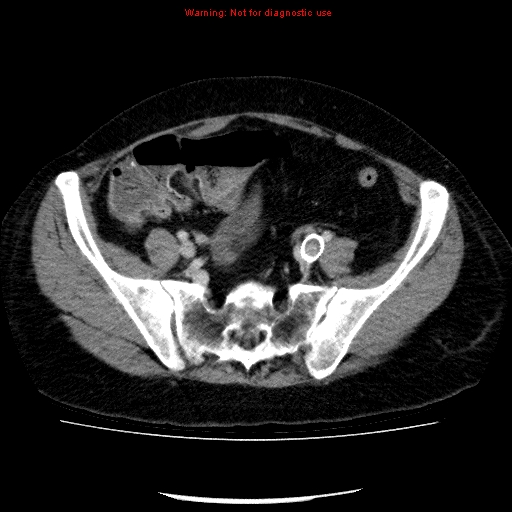 Acute gangrenous cholecystitis (Radiopaedia 10123-10661 Axial C+ portal venous phase 79).jpg