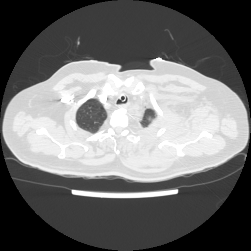 File:Acute heart failure (CT) (Radiopaedia 79835-93075 Axial lung window 4).png