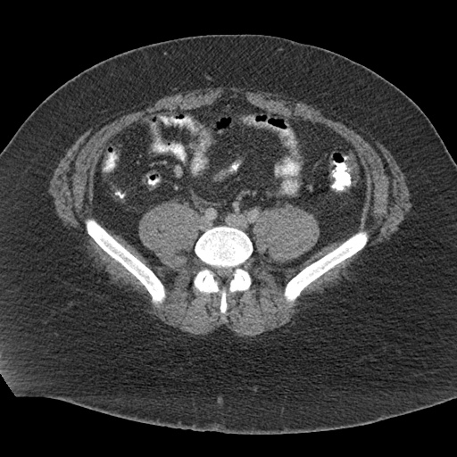 Acute mesenteric venous ischemia (Radiopaedia 46041-50383 Axial C+ portal venous phase 93).jpg