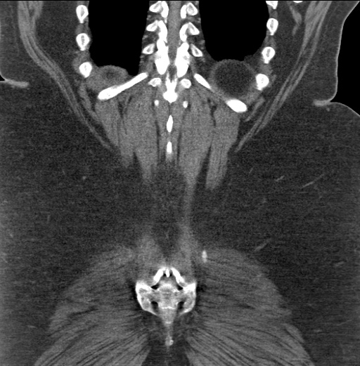 Acute mesenteric venous ischemia (Radiopaedia 46041-50383 Coronal C+ portal venous phase 85).jpg