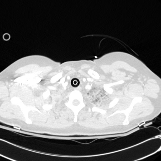 Acute myocardial infarction in CT (Radiopaedia 39947-42415 Axial lung window 9).jpg