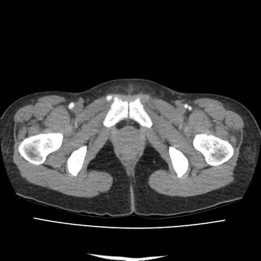 File:Acute myocarditis (Radiopaedia 55988-62613 Axial C+ portal venous phase 83).jpg