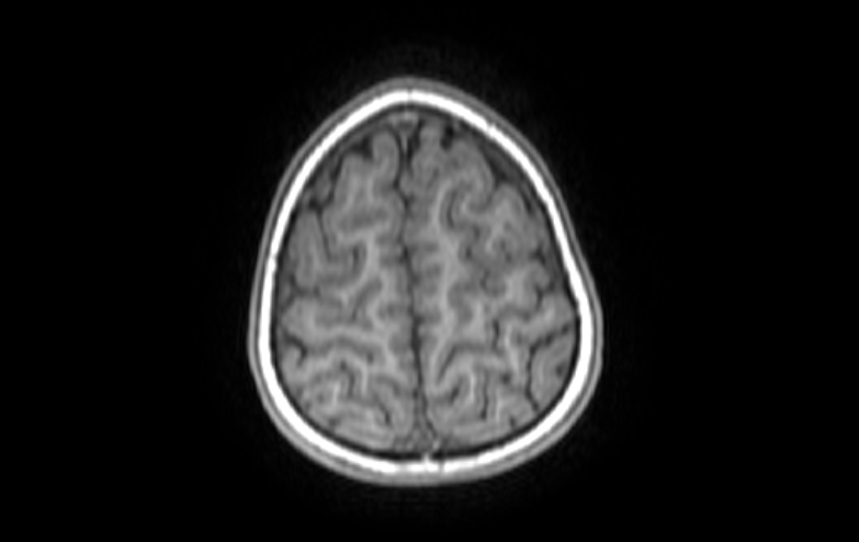 Acute necrotizing encephalitis of childhood (Radiopaedia 67356-76737 Axial T1 12).jpg
