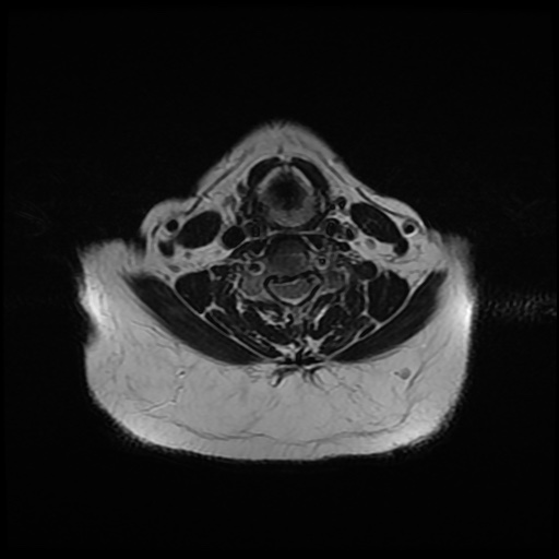 File:Acute otitis externa (Radiopaedia 57296-64236 Axial T2 25).jpg