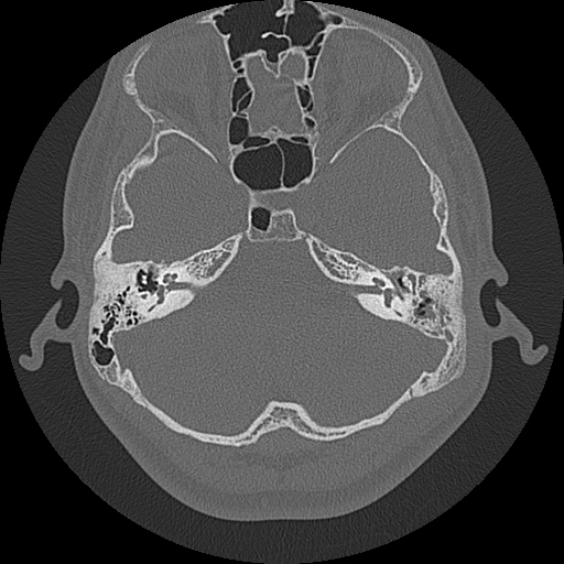 Acute otomastoiditis and Bezold abscess (Radiopaedia 88184-104786 Axial bone window 35).jpg