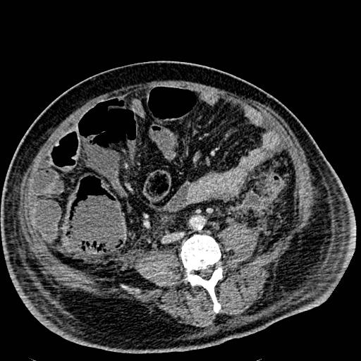 Acute pancreatic necrosis (Radiopaedia 13560-18501 Axial C+ portal venous phase 90).jpg
