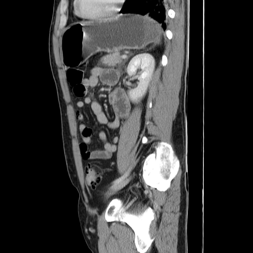 Acute pancreatitis (Radiopaedia 22572-22596 Sagittal C+ portal venous phase 37).jpg