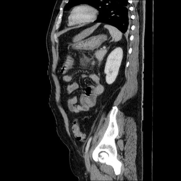 Acute pancreatitis (Radiopaedia 26663-26813 Sagittal C+ portal venous phase 55).jpg