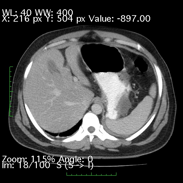 Acute pancreatitis (Radiopaedia 34043-35276 Axial C+ portal venous phase 18).jpg