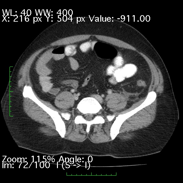 File:Acute pancreatitis (Radiopaedia 34043-35276 Axial C+ portal venous phase 72).jpg