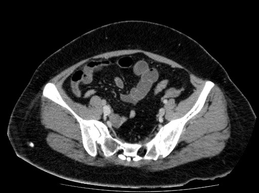 Acute pancreatitis (Radiopaedia 69236-79012 Axial C+ portal venous phase 73).jpg
