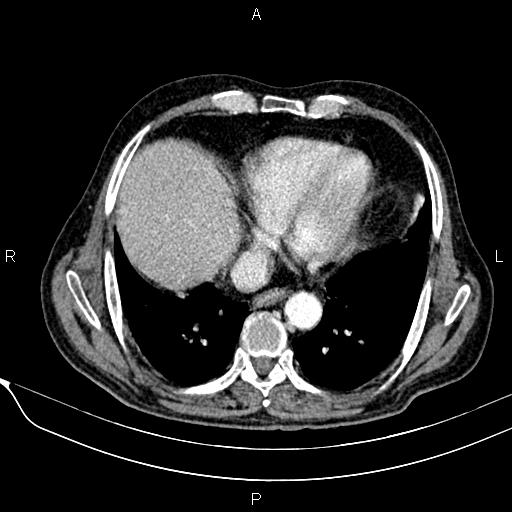 File:Acute pancreatitis (Radiopaedia 85146-100701 Axial C+ arterial phase 21).jpg