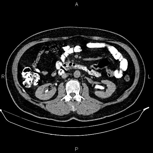 Acute pancreatitis (Radiopaedia 85390-101010 Axial C+ delayed 39).jpg