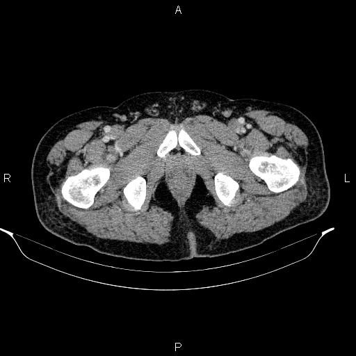 Acute pancreatitis (Radiopaedia 85390-101010 Axial C+ portal venous phase 114).jpg