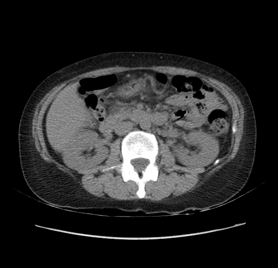 File:Acute pancreatitis - Balthazar E - post ERCP (Radiopaedia 27562-27772 Axial non-contrast 26).png