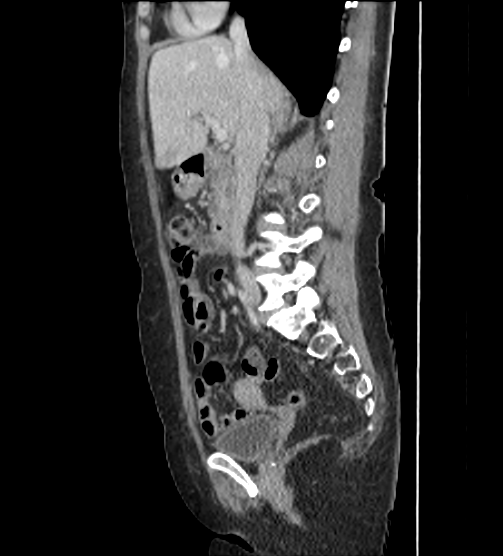 File:Acute pancreatitis - Balthazar E - post ERCP (Radiopaedia 27562-27772 Sagittal C+ portal venous phase 54).png