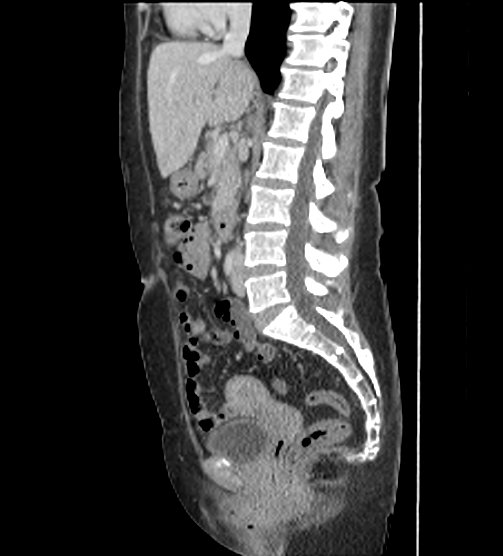 Acute pancreatitis - Balthazar E - post ERCP (Radiopaedia 27562-27772 Sagittal C+ portal venous phase 64).png