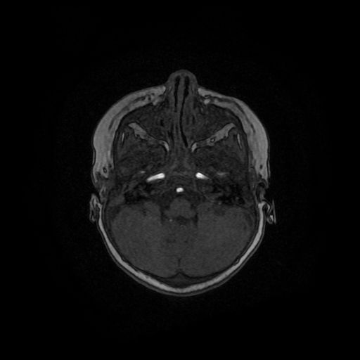 Acute phase of hemiconvulsion-hemiplegia epilepsy syndrome (Radiopaedia 29309-29745 Axial TOF angiography 121).jpg