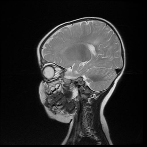 File:Acute phase of hemiconvulsion-hemiplegia epilepsy syndrome (Radiopaedia 29309-29745 Sagittal T2 8).jpg
