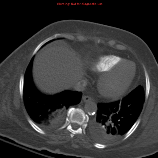 Acute pulmonary embolism (Radiopaedia 13286-13289 Axial C+ CTPA 51).jpg