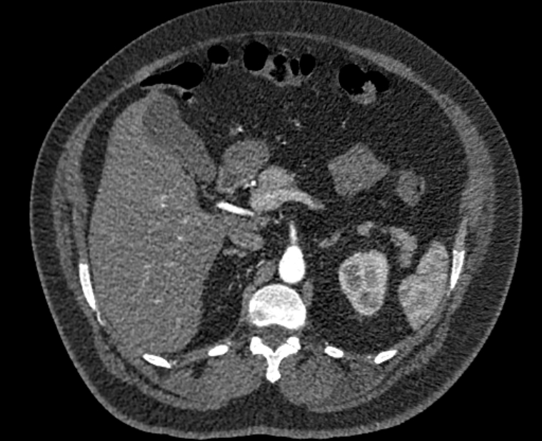 Acute pulmonary embolism with pulmonary infarcts (Radiopaedia 77688-89908 Axial C+ CTPA 82).jpg