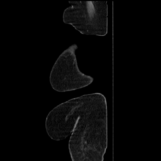 Acute pyelonephritis (Radiopaedia 25657-25837 Sagittal renal parenchymal phase 6).jpg
