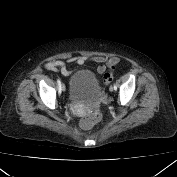 Acute pyelonephritis (Radiopaedia 26584-26729 Axial renal cortical phase 64).jpg