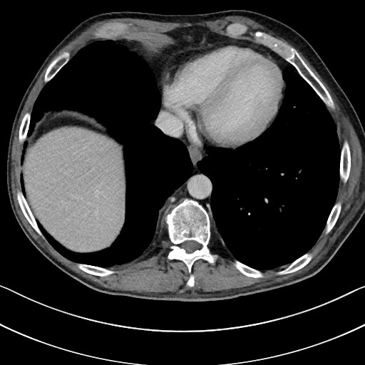 Acute renal infarction - rim capsular enhancement (Radiopaedia 59833-67270 Axial C+ portal venous phase 9).jpg