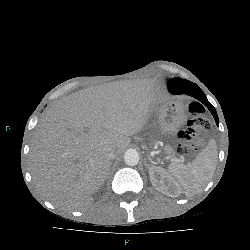 File:Acute right lung abscess (Radiopaedia 34806-36258 Axial C+ arterial phase 179).jpg