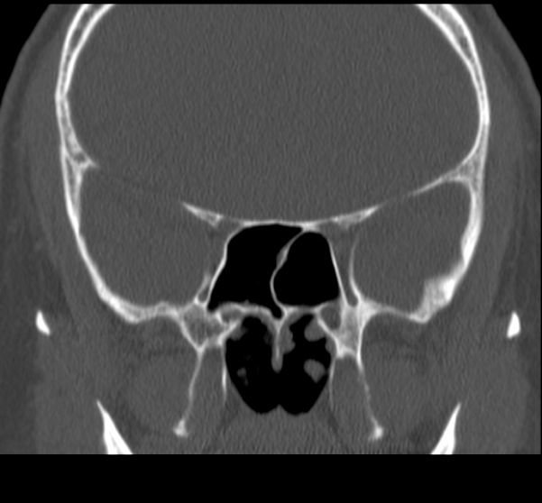 Acute sinusitis (Radiopaedia 23161-23215 Coronal bone window 46).jpg