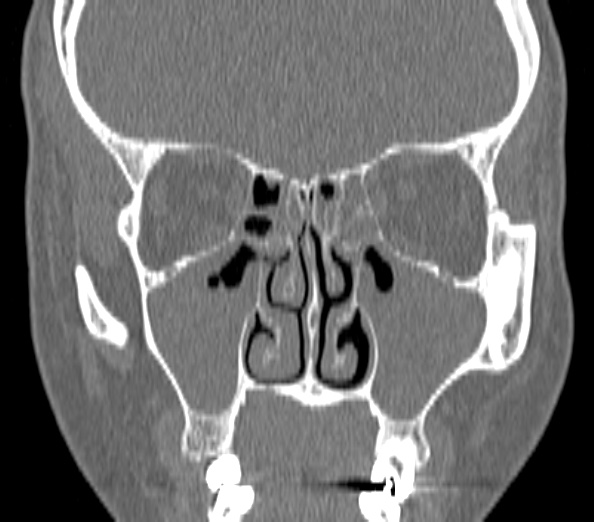 Acute sinusitis (Radiopaedia 40564-43158 Coronal bone window 20).jpg