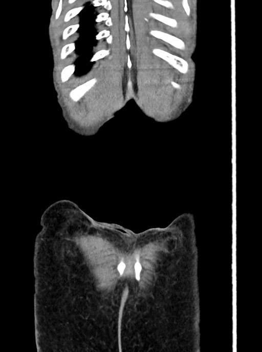 Acute small bowel (ileal) volvulus (Radiopaedia 71740-82139 Coronal C+ portal venous phase 108).jpg