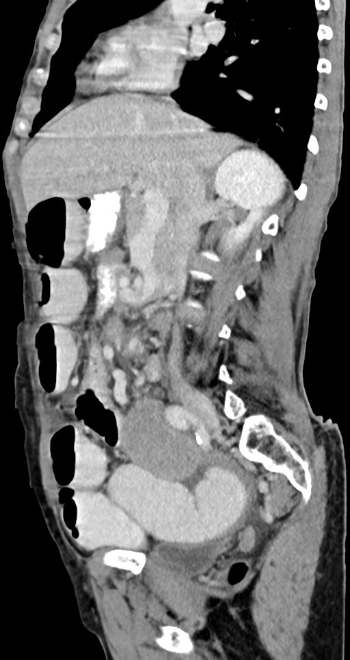 Acute small bowel (ileal) volvulus (Radiopaedia 71740-82139 Sagittal C+ portal venous phase 101).jpg
