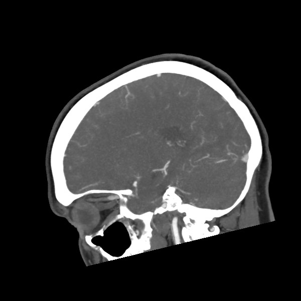 Acute subarachnoid hemorrhage and accessory anterior cerebral artery (Radiopaedia 69231-79009 Sagittal C+ arterial phase 28).jpg