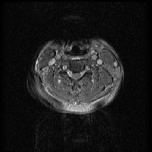Acute traumatic non-hemorrhagic central cord syndrome (Radiopaedia 39562-41869 Axial Gradient Echo 40).png