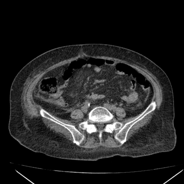 Acute tubular necrosis (Radiopaedia 28077-28334 Axial non-contrast 46).jpg
