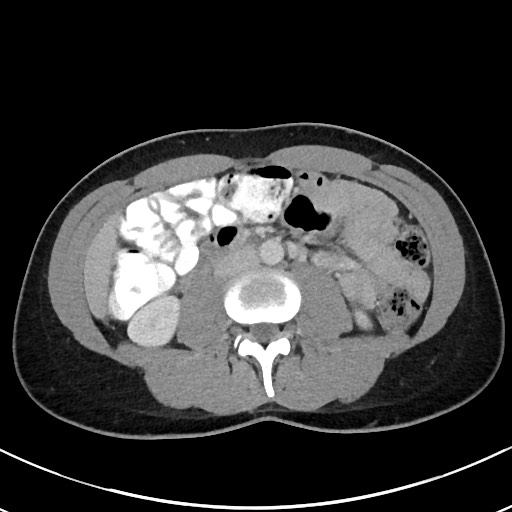File:Acute uncomplicated appendicitis (Radiopaedia 61374-69304 Axial 37).jpg