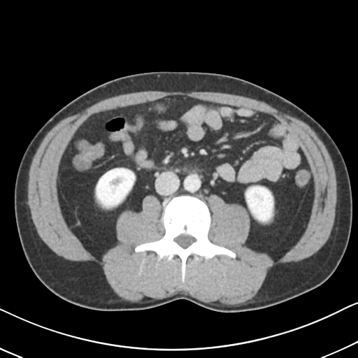 Acute uncomplicated appendicitis (Radiopaedia 88350-104982 Axial C+ portal venous phase 41).png