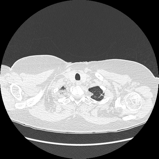 Adenocarcinoma in situ of lung (Radiopaedia 38685-40829 B 15).png