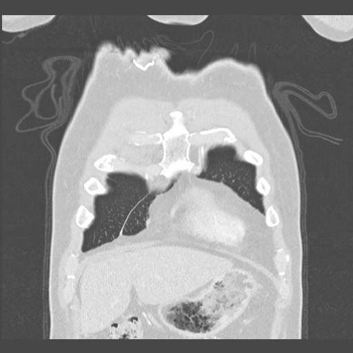 Adenocarcinoma of the lung (Radiopaedia 59871-67325 Coronal lung window 2).jpg