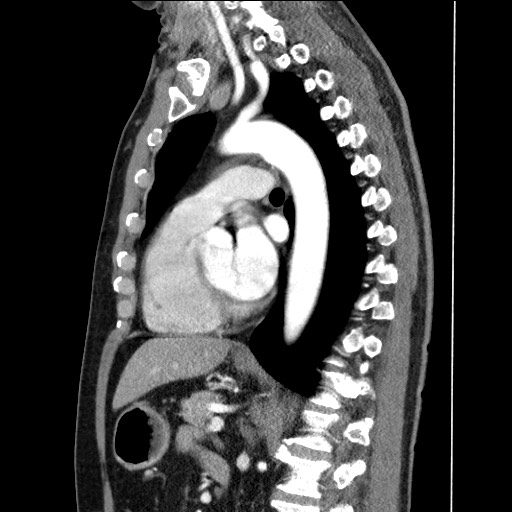 Adenocarcinoma of the lung (Radiopaedia 59871-67325 Sagittal C+ arterial phase 59).jpg